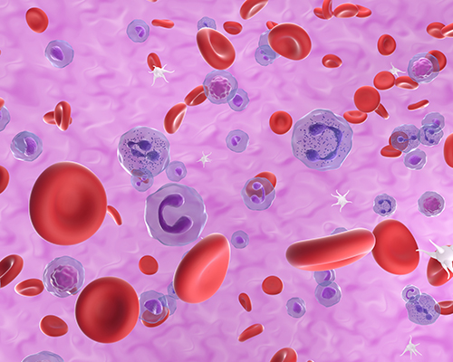 Myelodysplastic Syndrome